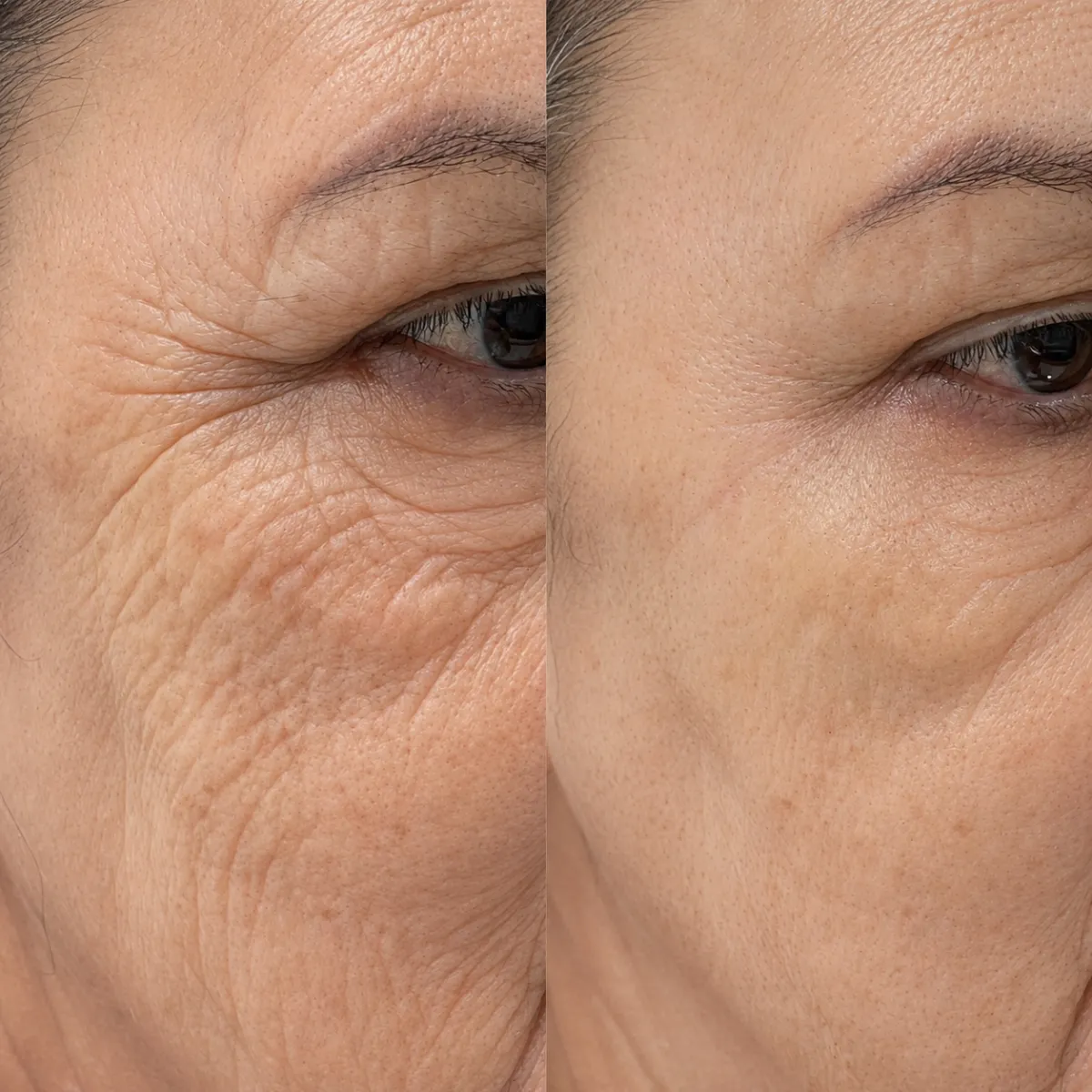 Elena, 54 — Deep expression lines & loss of firmness — before and after