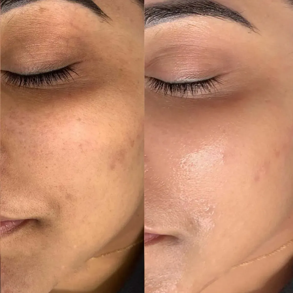 Sofia, 38 — Uneven tone & loss of radiance — before and after